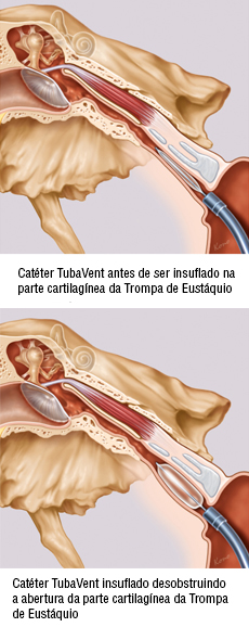 Dilatación de la trompa de Eustaquio con el catéter Bielefeld